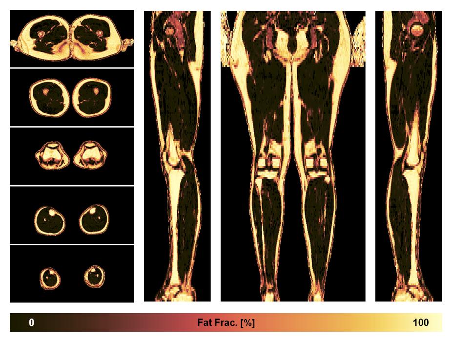 The fat fraction of the lower extremity obtained from the dixon reconstruction for muscle water fat quantification.